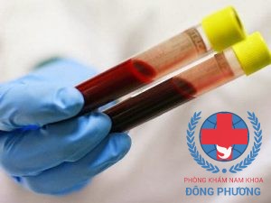 Xét nghiệm máu là một trong các xét nghiệm viêm niệu đạo