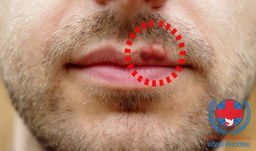 Herpes miệng ở nam giới phải giải quyết thế nào?