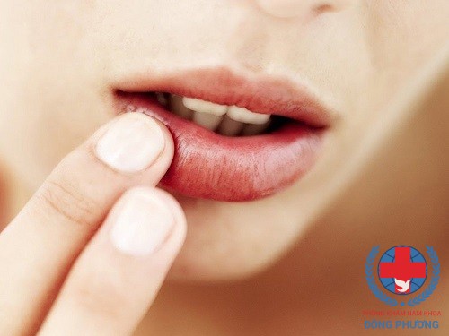 Mụn rộp ở miệng – căn bệnh phiền toái hầu như ai cũng mắc